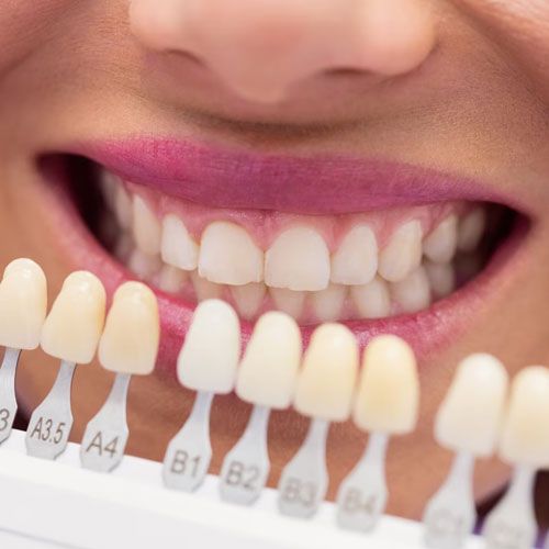 Dental Veneers