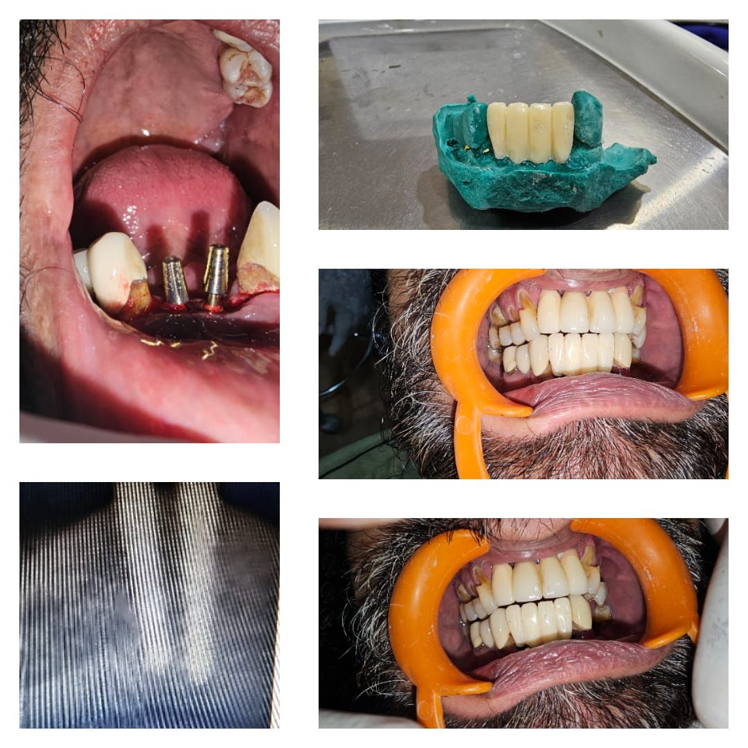 DENTAL IMPLANTS