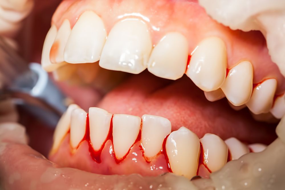 GINGIVAL (GUM )BLEEDING