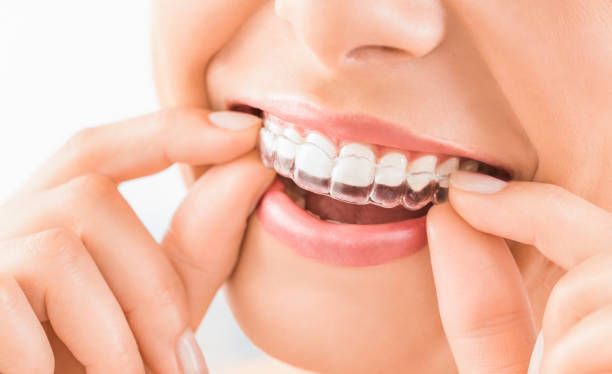 INVISALIGN AN ALTERNATIVE TO TRADITIONAL BRACES