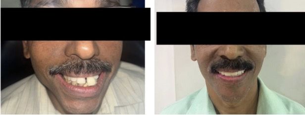 BASAL IMPLANTS :An Immediate Alternative for Replacing MissingTeeth