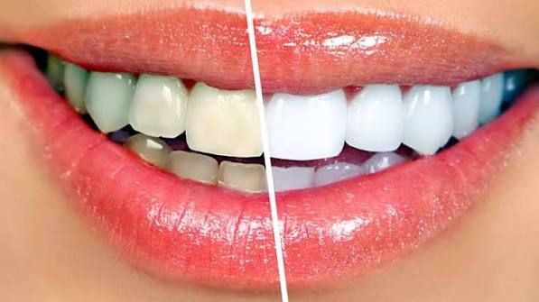 Yellow Teeth: Causes and Safe Whitening Options